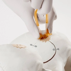 Cranial COVER® – Acoperire Estetică și Sigură pentru Găurile de Trepanație | Neos Surgery - Img 3