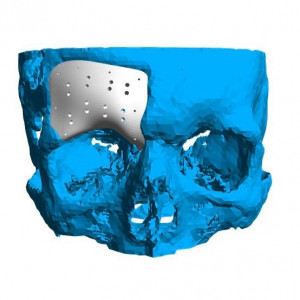 Cranioplasty plate for ENT defects - Img 7