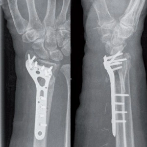 Placa de Radius Distal poliaxiala pentru osteointeza fracturii de radius 