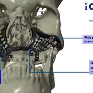 iCMF Ti – Implant Craniomaxilofacial Personalizat din Titan | BoneEasy® - Img 3