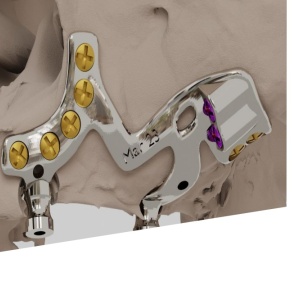 Implant personalizat pentru maxilar, subperiostal – Implantize Compact (Titanium / PEEK) (BoneEasy)