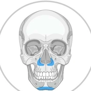 Implanturi Personalizate pentru Augmentarea Feței și Craniului | Chirurgie Plastică și Estetică, MEDPRIN - Img 4