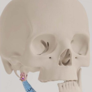 Patient-specific Temporomandibular Joint Endoprosthesis - Img 2