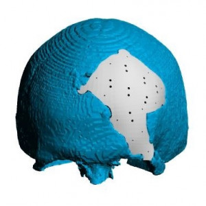 Placa (Cranioplastie), defecte craniene - Img 5