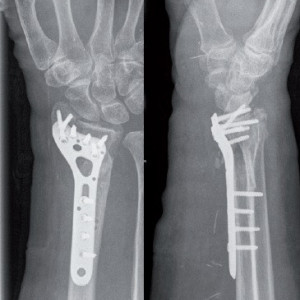 Placa de Radius Distal poliaxiala pentru osteointeza fracturii de radius 