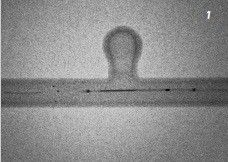 ACCERO, stent tipă braided  pentru tratamentul anevrismelor intracraniene.