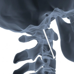 Șurub Canulat ATLAS din Titan – Fixare Odontoidă C2 în Traumă Cervicală - Img 2
