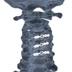 ULTIO LAMINOPLASTY POSTERIOR CERVICAL SPINAL FIXATION SYSTEM - Img 5