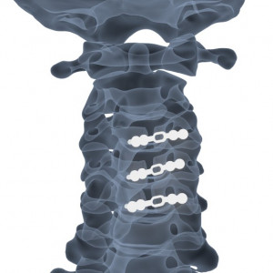 ULTIO Placă Laminoplastie Cervicală | Sistem Fixare Coloană - Img 5