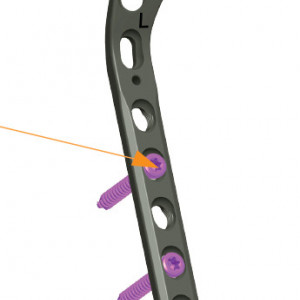 Placa de tibie proximala poliaxiala pentru osteosinteza fracturii de tibie Enlife