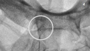 ACCERO, stent tipă braided  pentru tratamentul anevrismelor intracraniene.