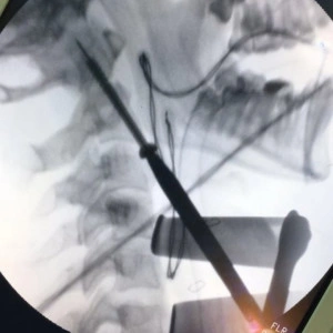 ATLAS ODONTOID SCREW - Img 3