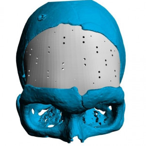 Cranioplasty patient-specific implants - Img 6