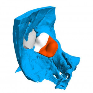 Cranioplasty plate for ENT defects - Img 8