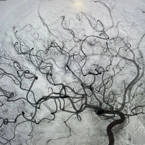 Pictura abstracta: The STROKE ( Accidentul Vascular Cerebral) sau Omul din Copacul Creierului - Img 2