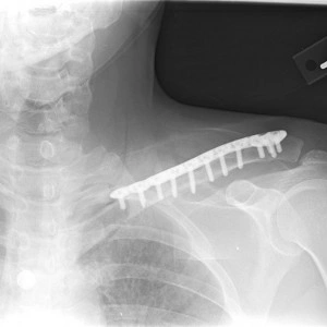 Placa cu extremitate laterala poliaxiala pentru osteointeza fracturii de clavicula