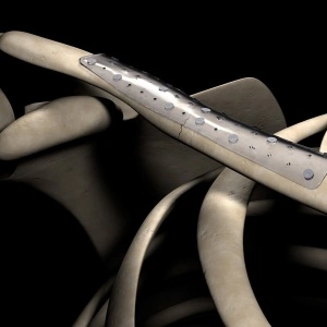 Sistem osteosinteză bioresorbabil Inion Freedom™ | Plăci și șuruburi interblocabile - Img 4