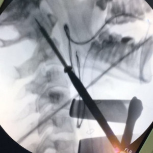 Șurub Canulat ATLAS din Titan – Fixare Odontoidă C2 în Traumă Cervicală - Img 3