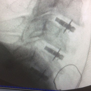 ARION EXPANDABLE BLADED CERVICAL PEEK CAGE - Img 2