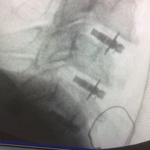 ARION EXPANDABLE BLADED CERVICAL PEEK CAGE - Img 2