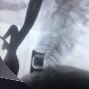 AURA ANTERIOR CERVICAL PLATE SYSTEM - Img 6