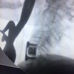 AURA ANTERIOR CERVICAL PLATE SYSTEM - Img 6