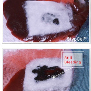 Hemostatic StypCel Enlife Solutions