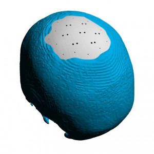 Placa (Cranioplastie), defecte craniene - Img 7