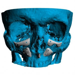 Placă Cranioplastie Personalizată 3D – Implant pentru Defecte BMF | 3di Germania - Img 2