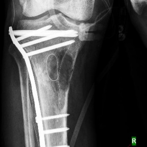Placa de tibie proximala poliaxiala pentru osteosinteza fracturii de tibie Enlife