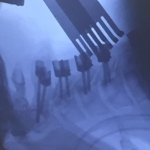 PORTHOS POSTERIOR CERVICAL SPINAL FIXATION SYSTEM - Img 4