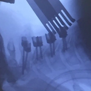 PORTHOS POSTERIOR CERVICAL SPINAL FIXATION SYSTEM - Img 4