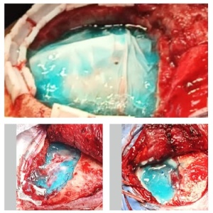 Sigilator de Dura Mater pentru Neurochirurgie Craniană și Spinală - Immiseal® - Img 4