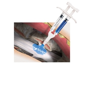 Sigilator de dura pentru chirurgie spinală – DuraSeal® 3 mL