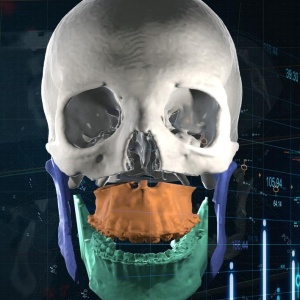 Software pentru planificare chirurgicală cranio-maxilo-facială, chirurgie ortognată – Mimics Enlight CMF (Materialise) - Img 4