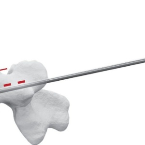 TRIPOD-FIX – Sistem Expandabil Vertebral pentru Fracturi de Compresie | Augmentare cu PMMA - Img 2