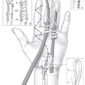 Universal Tendon Spacer U.T.S. – Distanțier Tendinos din Silicon pentru Reconstrucția Tendoanelor Flexorilor și Extensorilor - Img 3