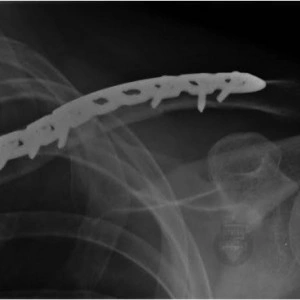 Placa in S poliaxiala pentru osteointeza fracturii de clavicula