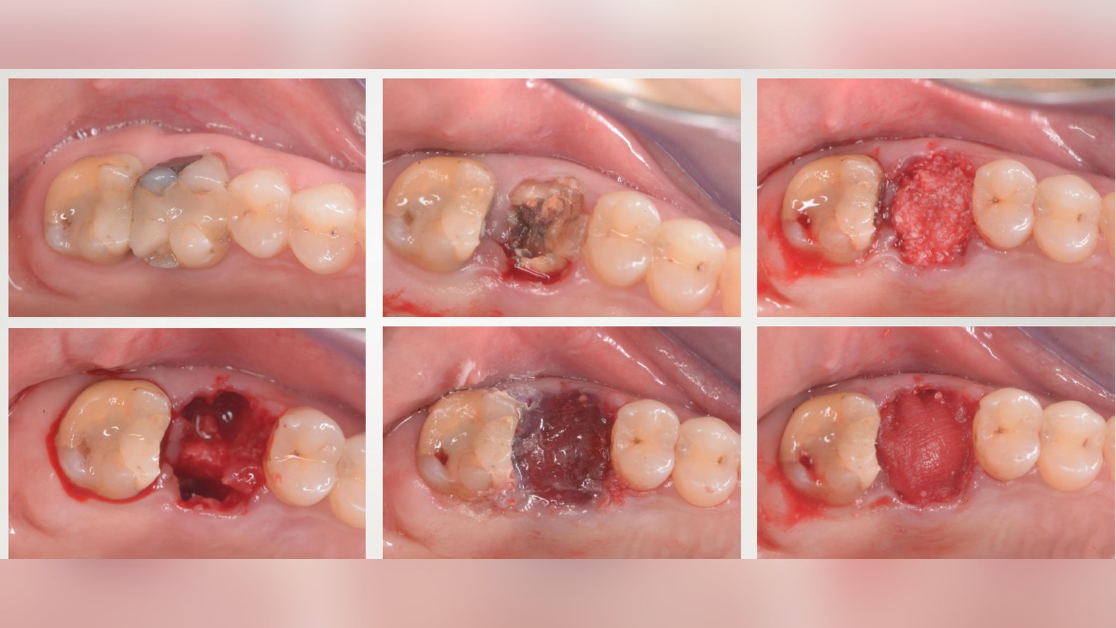 Cuantum Oral Adhesive autopolimerizabil: indicații și utilizare pe tipuri de plăgi orale