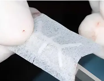 SimplySilk® vs. Mesh de Titan: Cum elimini a doua intervenție fără să pierzi volumul