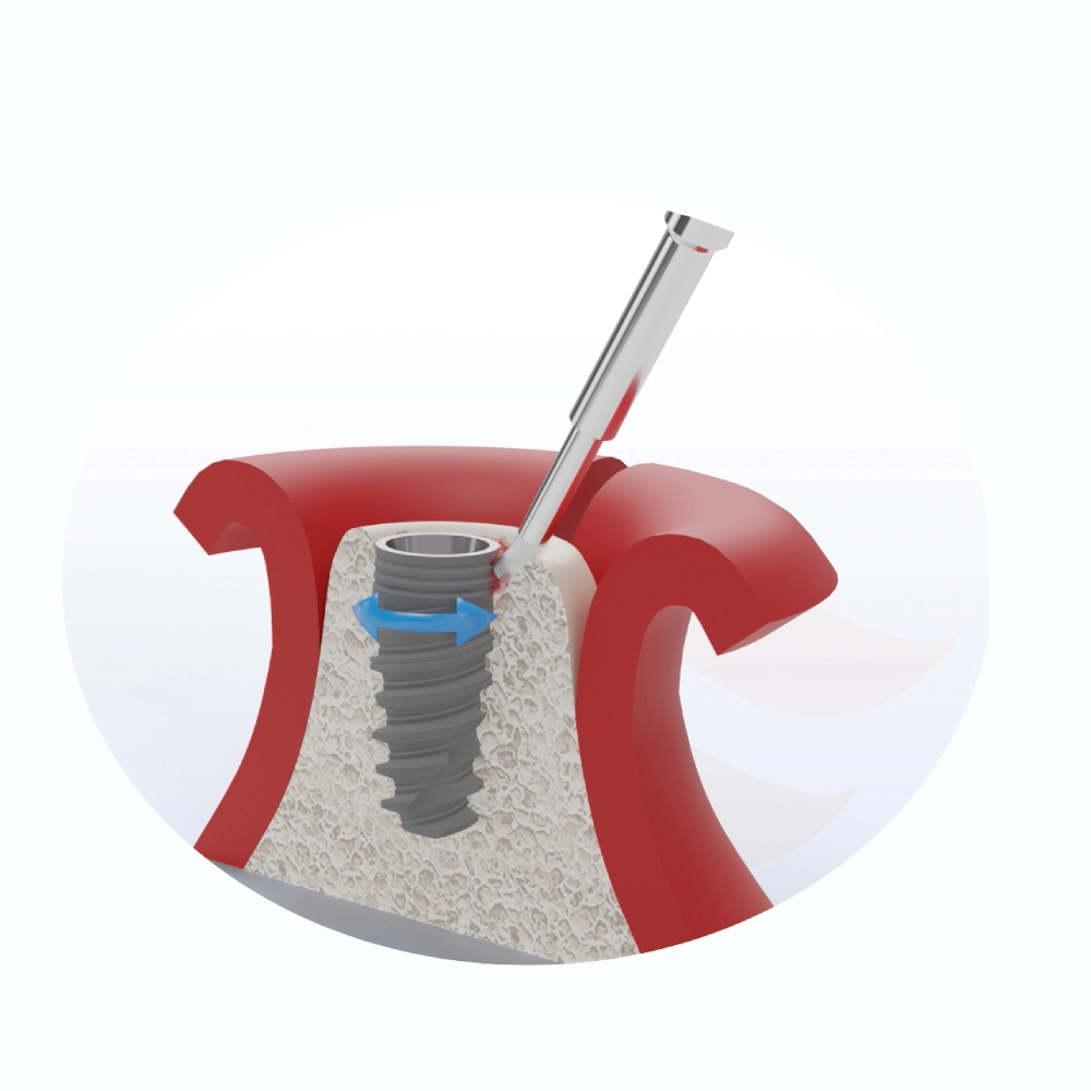 Peri-implantita: Ce este, cum o recunoști și de ce apare?