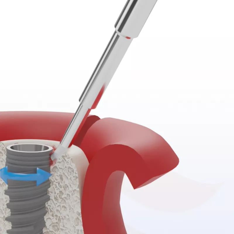 Cum se tratează peri-implantita? Soluții moderne în cabinetul stomatologic