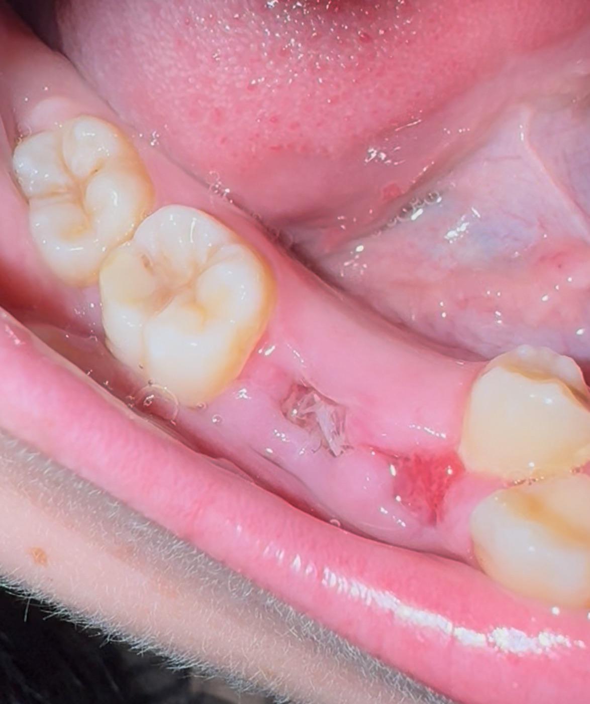 Osteita alveolara si plagile orale dificile