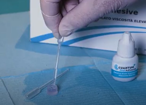 Situații utilizare pentru Cuantum Oral Adhesive și Cuantum Light Curing Oral Adhesive