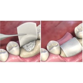 "Membranele de colagen: solutia moderna pentru tratamente dentare"