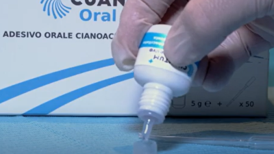 Avantaje Clinice Cheie: Reducerea Durerii, Vindecare Accelerată și Confort Sporit pentru Pacient