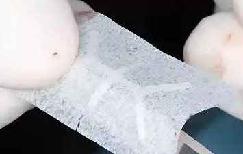 SimplySilk® vs. Mesh de Titan: Cum elimini a doua intervenție fără să pierzi volumul