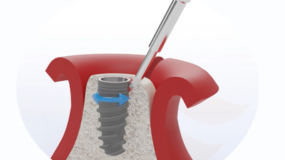 Peri-implantita: Ce este, cum o recunoști și de ce apare?