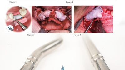 GBR si membrane - stabilizarea materialelor de grefa