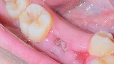 Osteita alveolara si plagile orale dificile